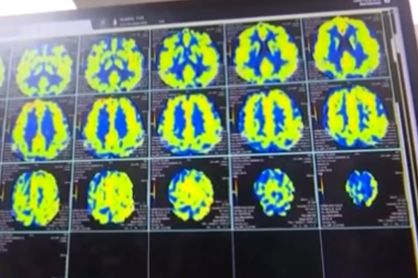 Dünyanın ilk invaziv BCI cihazına Çin’den onay